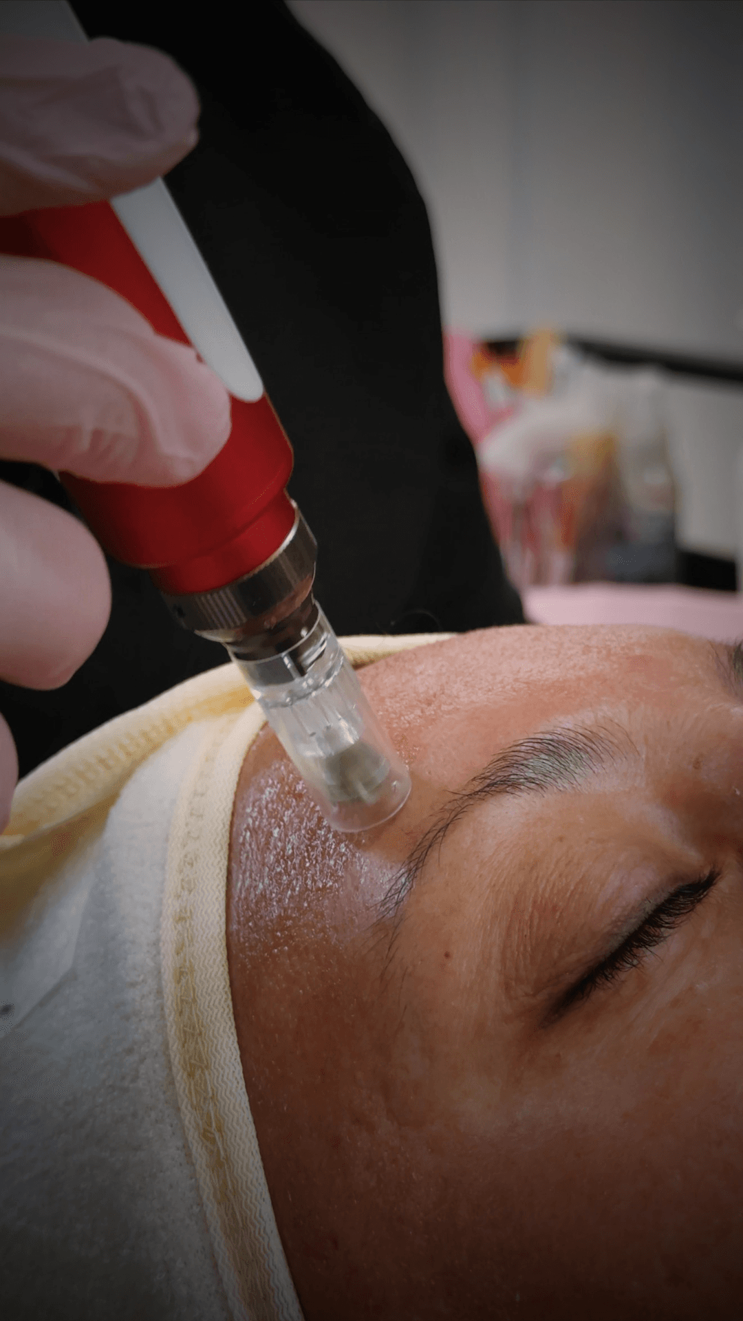 MICRONEEDLING